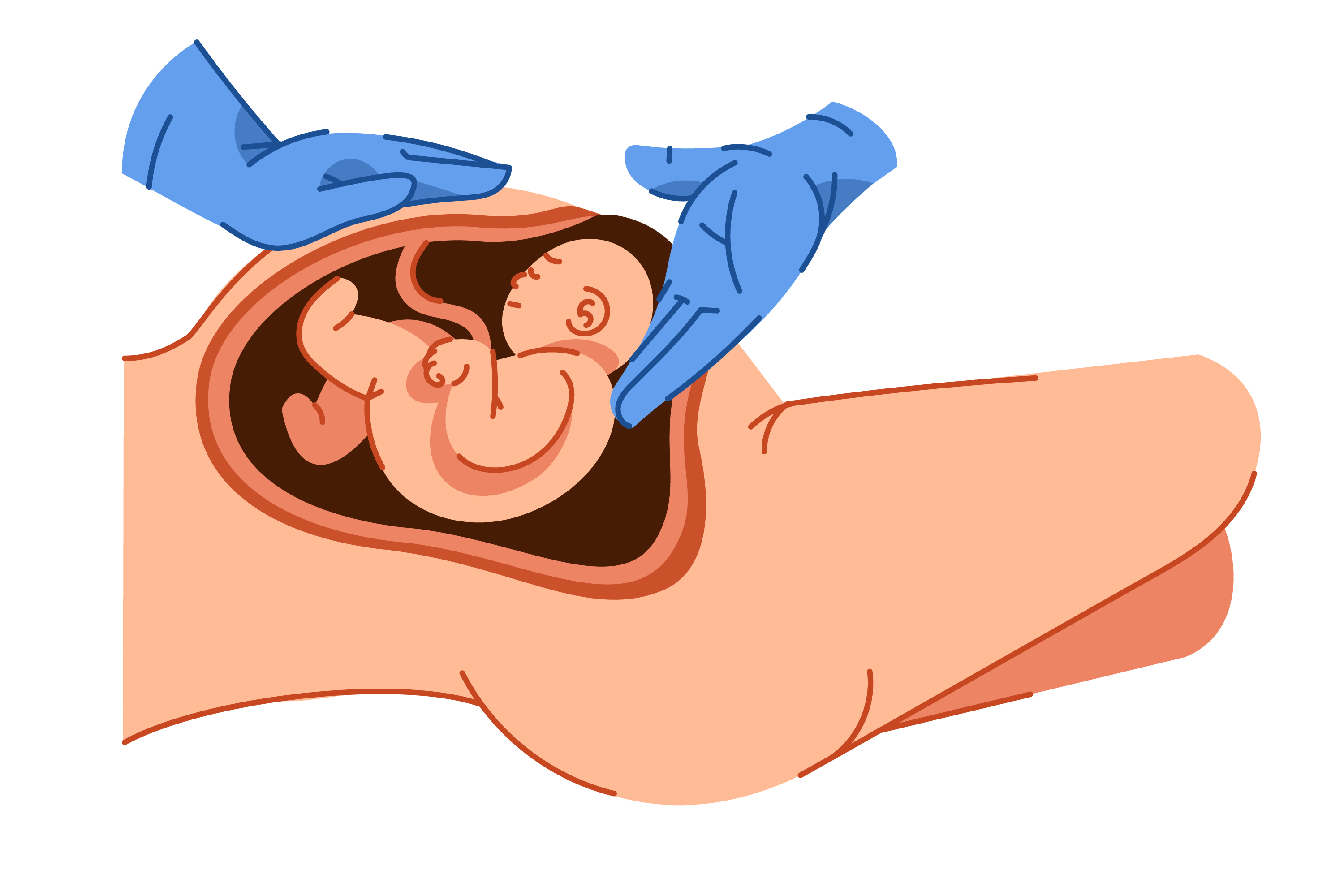 Cesarean Section